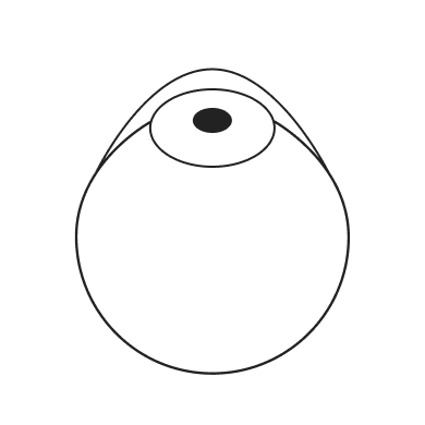 (Laser-Assisted In Situ Keratomileusis)